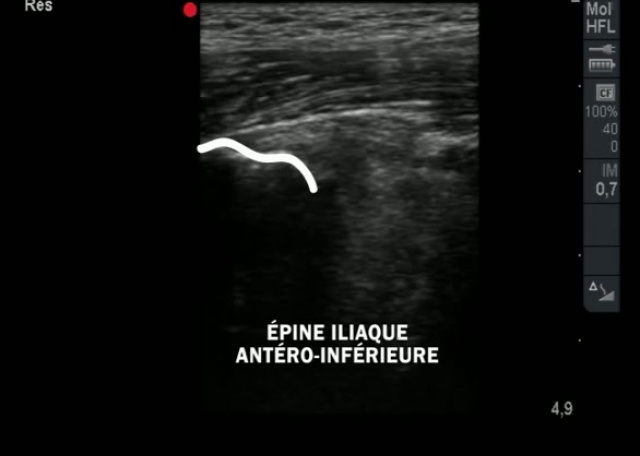 Debuter En Echo Anatomie De Hanche Hors Nourrisson