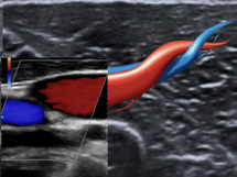 L'essentiel du doppler pour le médecin généraliste