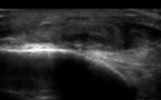 Rupture partielle du tendon tibial antérieur